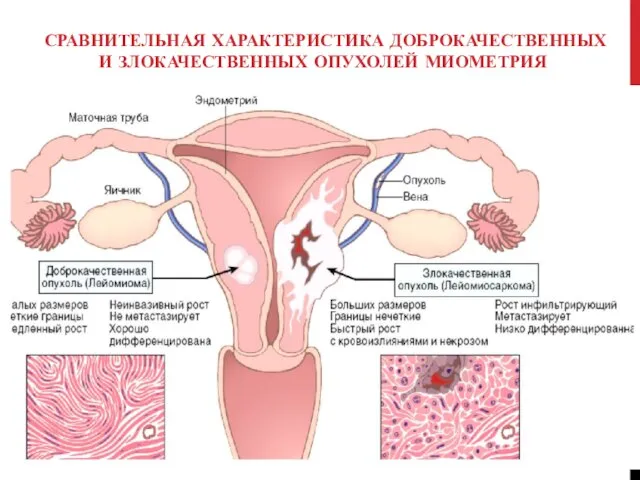 СРАВНИТЕЛЬНАЯ ХАРАКТЕРИСТИКА ДОБРОКАЧЕСТВЕННЫХ И ЗЛОКАЧЕСТВЕННЫХ ОПУХОЛЕЙ МИОМЕТРИЯ