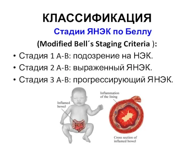 КЛАССИФИКАЦИЯ Стадии ЯНЭК по Беллу (Modified Bell´s Staging Criteria ): Стадия