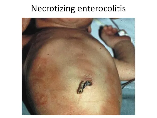 Necrotizing enterocolitis