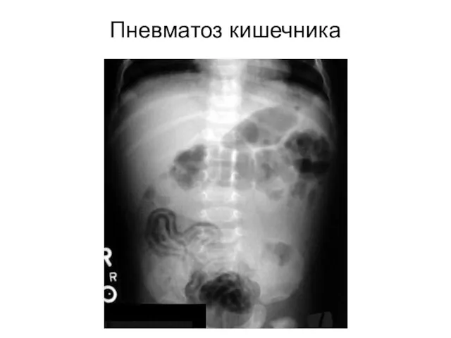 Пневматоз кишечника