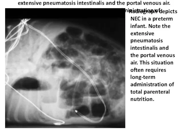 Radiograph depicts NEC in a preterm infant. Note the extensive pneumatosis