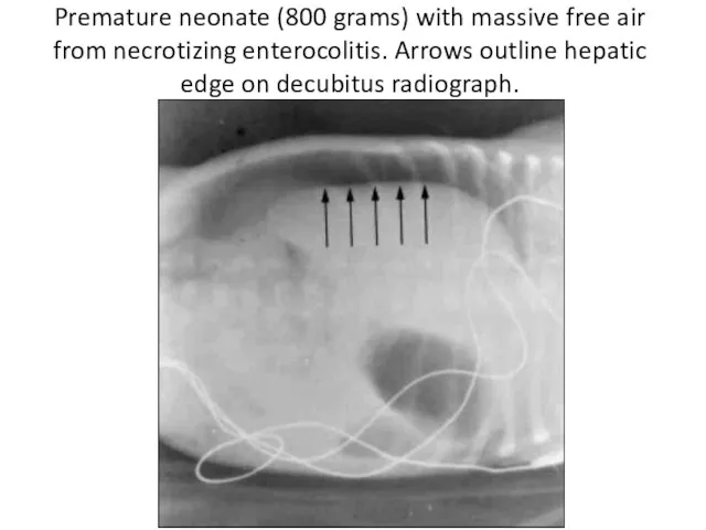 Premature neonate (800 grams) with massive free air from necrotizing enterocolitis.