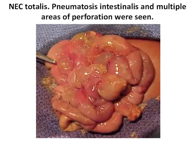 NEC totalis. Pneumatosis intestinalis and multiple areas of perforation were seen.