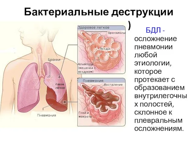 Бактериальные деструкции легких (БДЛ) БДЛ - осложнение пневмонии любой этиологии, которое