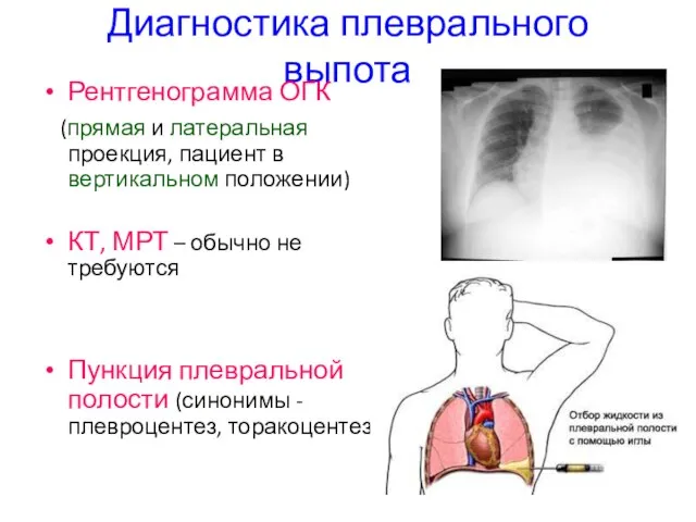 Диагностика плеврального выпота Рентгенограмма ОГК (прямая и латеральная проекция, пациент в