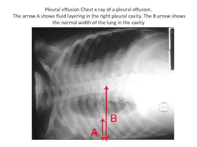 Pleural effusion Chest x-ray of a pleural effusion. The arrow A