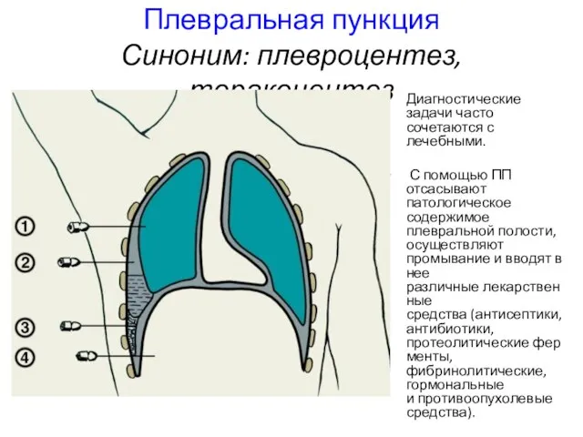 Плевральная пункция Синоним: плевроцентез, торакоцентез Диагностические задачи часто сочетаются с лечебными.