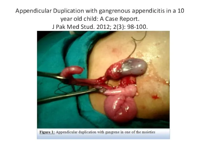 Appendicular Duplication with gangrenous appendicitis in a 10 year old child: