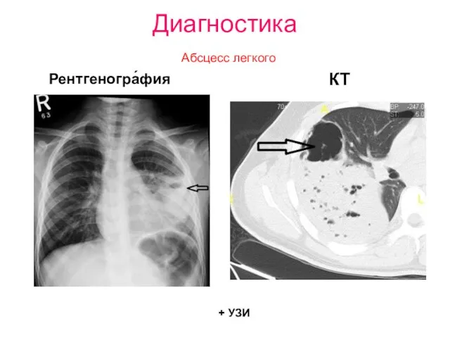 Диагностика Абсцесс легкого Рентгеногра́фия КТ + УЗИ