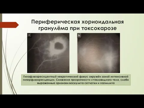 Периферическая хориоидальная гранулёма при токсокарозе Гипофлюореснцентный некротический фокус окружён зоной интенсивной