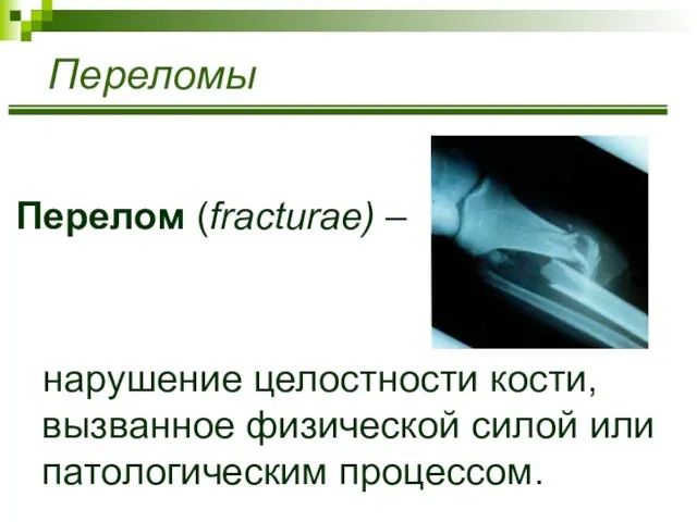 Переломы Перелом (fracturae) – нарушение целостности кости, вызванное физической силой или патологическим процессом.