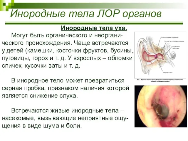 Инородные тела ЛОР органов Инородные тела уха. Могут быть органического и