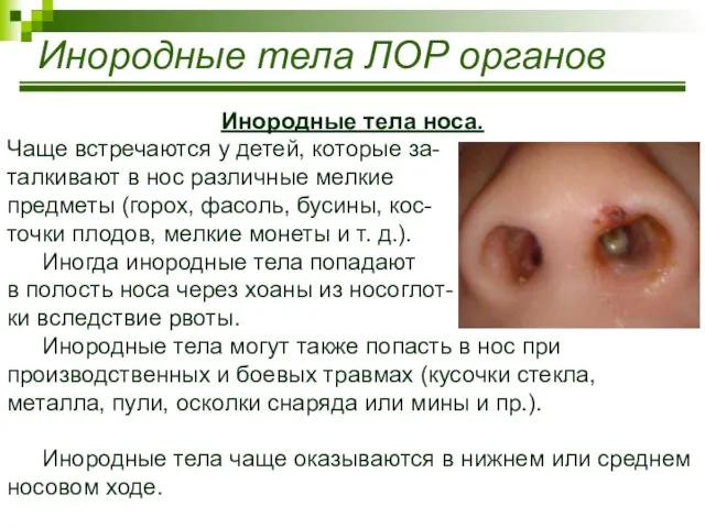 Инородные тела ЛОР органов Инородные тела носа. Чаще встречаются у детей,