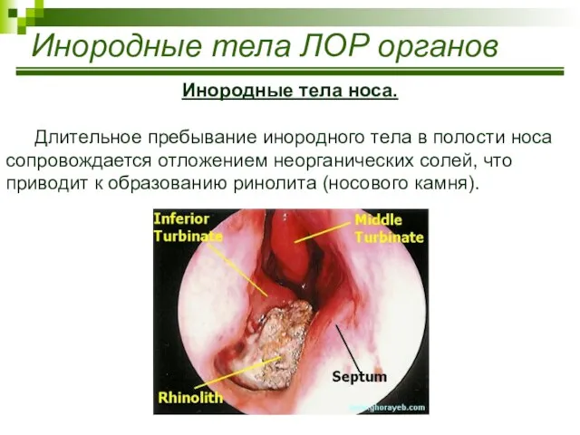 Инородные тела ЛОР органов Инородные тела носа. Длительное пребывание инородного тела