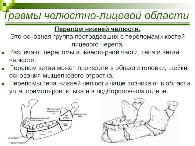 Травмы челюстно-лицевой области Перелом нижней челюсти. Это основная группа пострадавших с