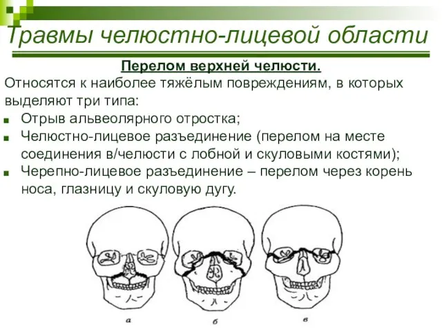 Травмы челюстно-лицевой области Перелом верхней челюсти. Относятся к наиболее тяжёлым повреждениям,