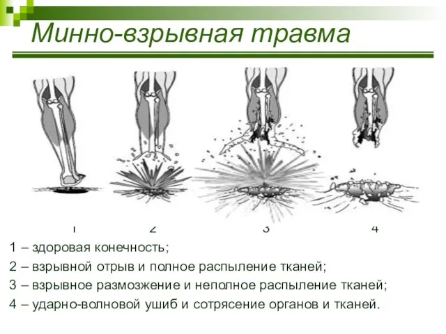 Минно-взрывная травма 1 2 3 4 1 – здоровая конечность; 2