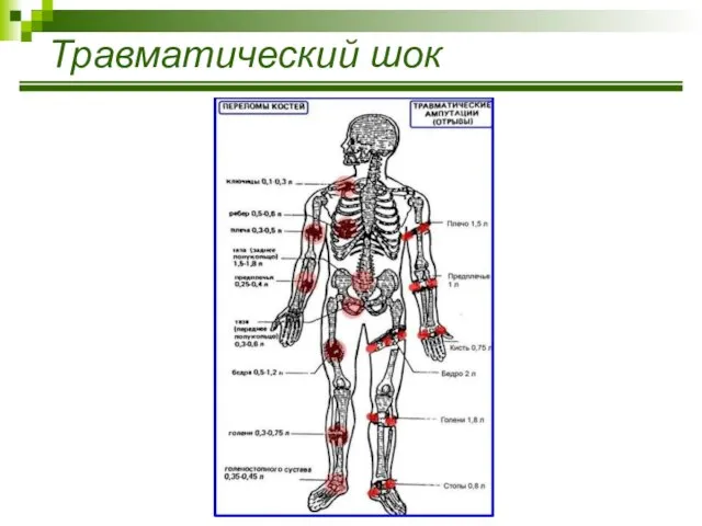 Травматический шок