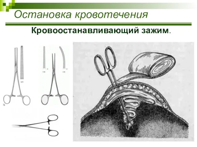 Остановка кровотечения Кровоостанавливающий зажим.