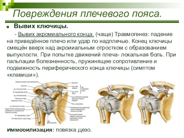 Вывих ключицы. - Вывих акромиального конца. (чаще) Травмогенез: падение на приведённое