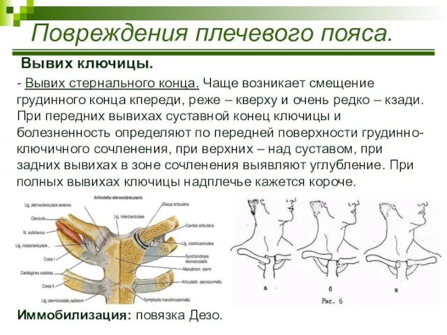 Вывих ключицы. - Вывих стернального конца. Чаще возникает смещение грудинного конца