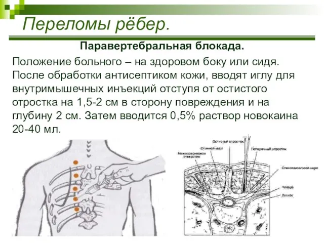 Паравертебральная блокада. Положение больного – на здоровом боку или сидя. После