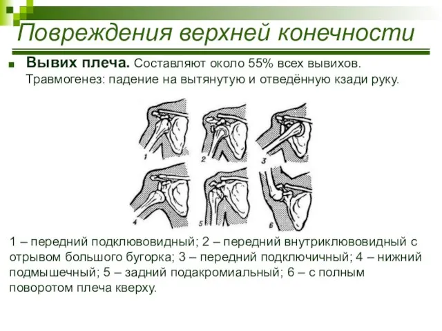 Вывих плеча. Составляют около 55% всех вывихов. Травмогенез: падение на вытянутую