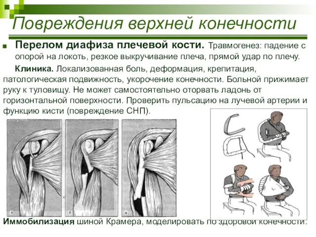 Перелом диафиза плечевой кости. Травмогенез: падение с опорой на локоть, резкое