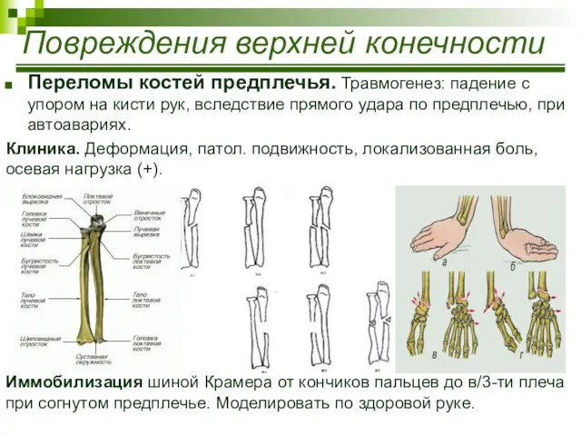 Переломы костей предплечья. Травмогенез: падение с упором на кисти рук, вследствие