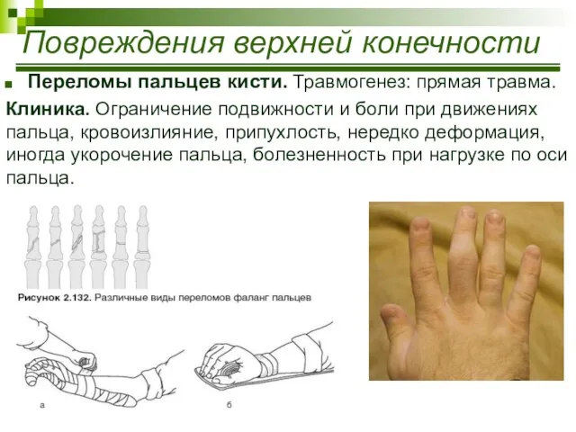 Переломы пальцев кисти. Травмогенез: прямая травма. Клиника. Ограничение подвижности и боли