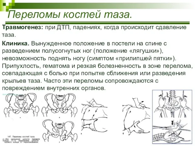 Травмогенез: при ДТП, падениях, когда происходит сдавление таза. Клиника. Вынужденное положение