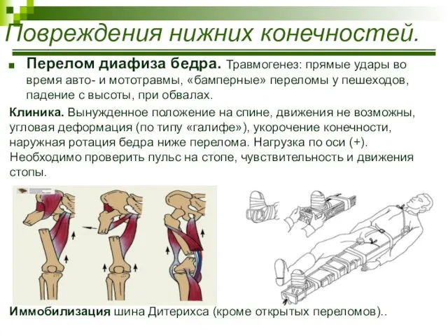 Перелом диафиза бедра. Травмогенез: прямые удары во время авто- и мототравмы,