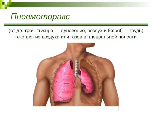 Пневмоторакс (от др.-греч. πνεῦμα — дуновение, воздух и θώραξ — грудь)