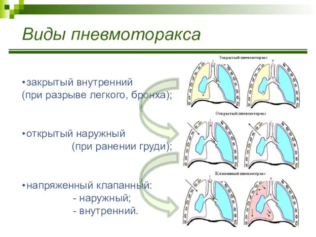 Виды пневмоторакса закрытый внутренний (при разрыве легкого, бронха); открытый наружный (при