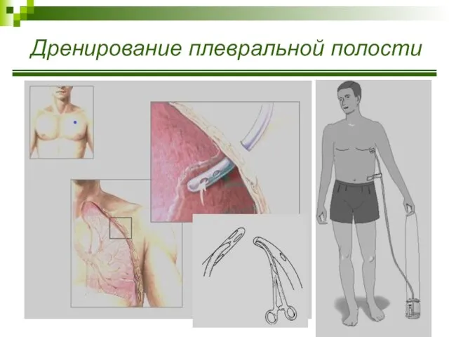 Дренирование плевральной полости