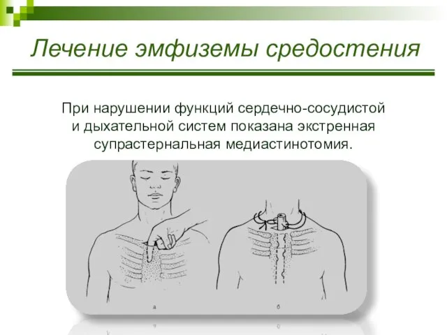 Лечение эмфиземы средостения При нарушении функций сердечно-сосудистой и дыхательной систем показана экстренная супрастернальная медиастинотомия.