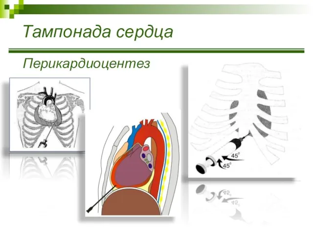 Тампонада сердца Перикардиоцентез