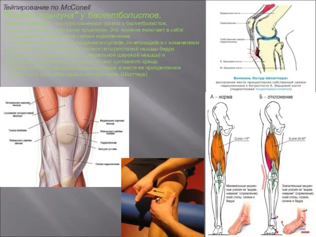 "Колено прыгуна" у баскетболистов. "Колено прыгуна" - распространенная травма у баскетболистов,
