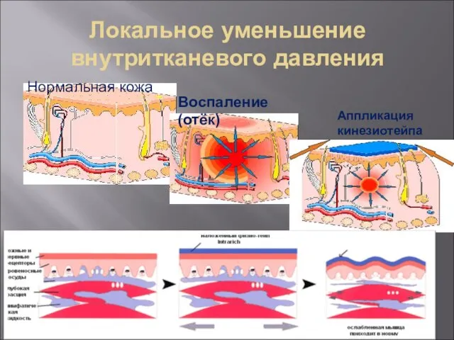 Локальное уменьшение внутритканевого давления Нормальная кожа Воспаление (отёк) Аппликация кинезиотейпа