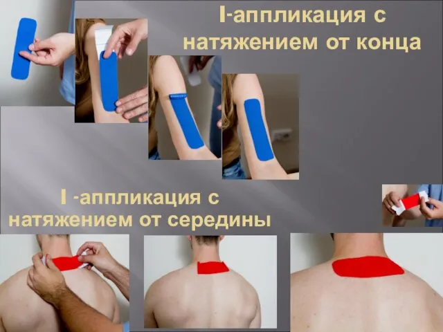 I-аппликация с натяжением от конца I -аппликация с натяжением от середины