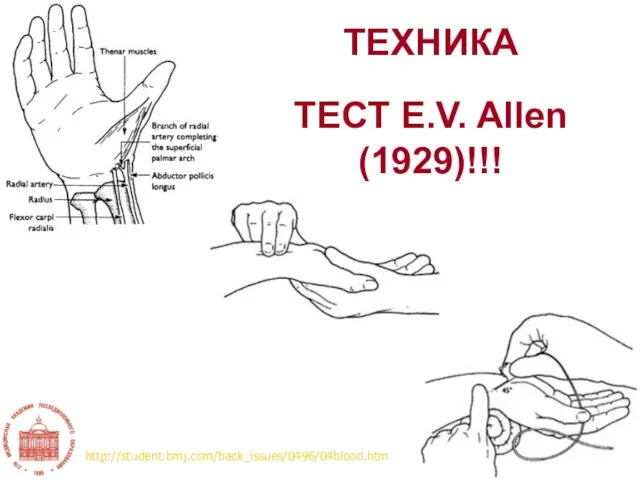 ТЕХНИКА http://student.bmj.com/back_issues/0496/04blood.htm ТЕСТ E.V. Allen (1929)!!!