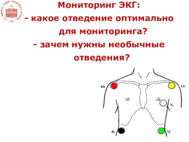 Мониторинг ЭКГ: - какое отведение оптимально для мониторинга? - зачем нужны необычные отведения?