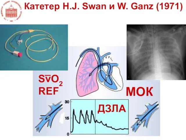 Катетер H.J. Swan и W. Ganz (1971) SvO2REF МОК ДЗЛА