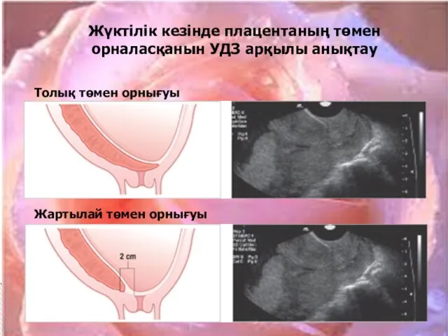 Жүктілік кезінде плацентаның төмен орналасқанын УДЗ арқылы анықтау Толық төмен орнығуы Жартылай төмен орнығуы