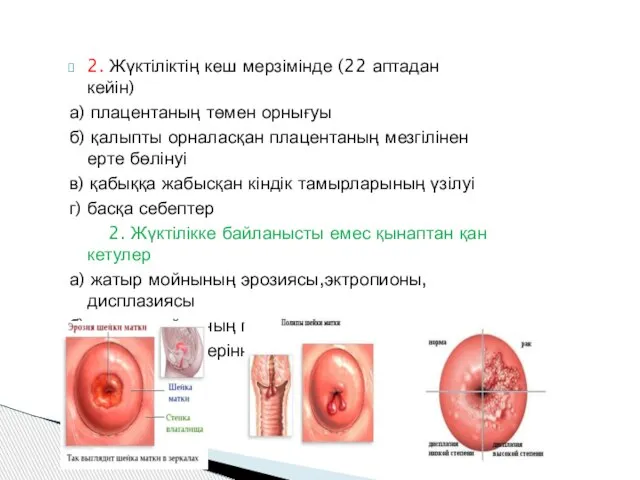 2. Жүктіліктің кеш мерзімінде (22 аптадан кейін) а) плацентаның төмен орнығуы