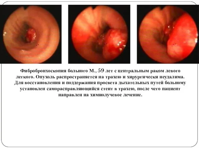 Фибробронхоскопия больного М., 59 лет с центральным раком левого легкого. Опухоль