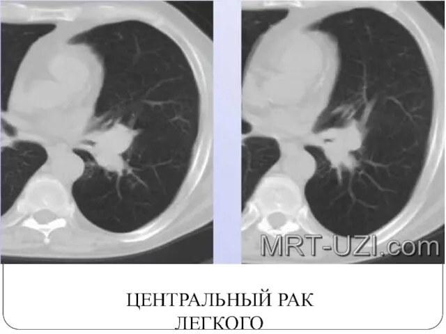 ЦЕНТРАЛЬНЫЙ РАК ЛЕГКОГО