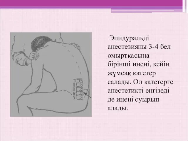 Эпидуральді анестезияны 3-4 бел омыртқасына бірінші инені, кейін жұмсақ катетер салады.