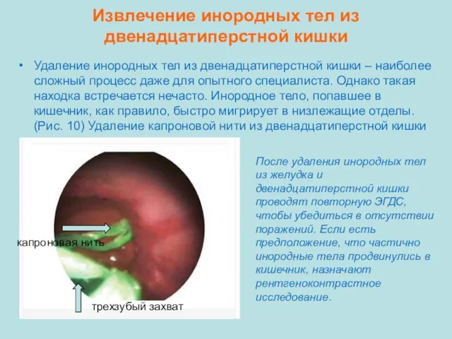 Извлечение инородных тел из двенадцатиперстной кишки Удаление инородных тел из двенадцатиперстной