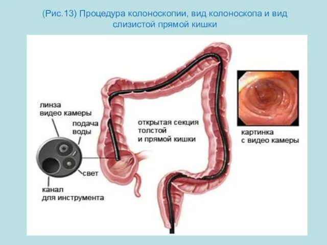 (Рис.13) Процедура колоноскопии, вид колоноскопа и вид слизистой прямой кишки